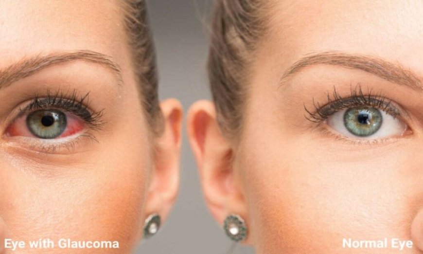 Foods That Support Eye Health and May Help Manage Glaucoma