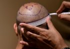 How to Find an Affordable Hair Transplant Clinic in Abu Dhabi