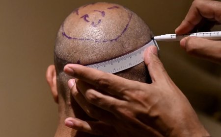 How to Find an Affordable Hair Transplant Clinic in Abu Dhabi