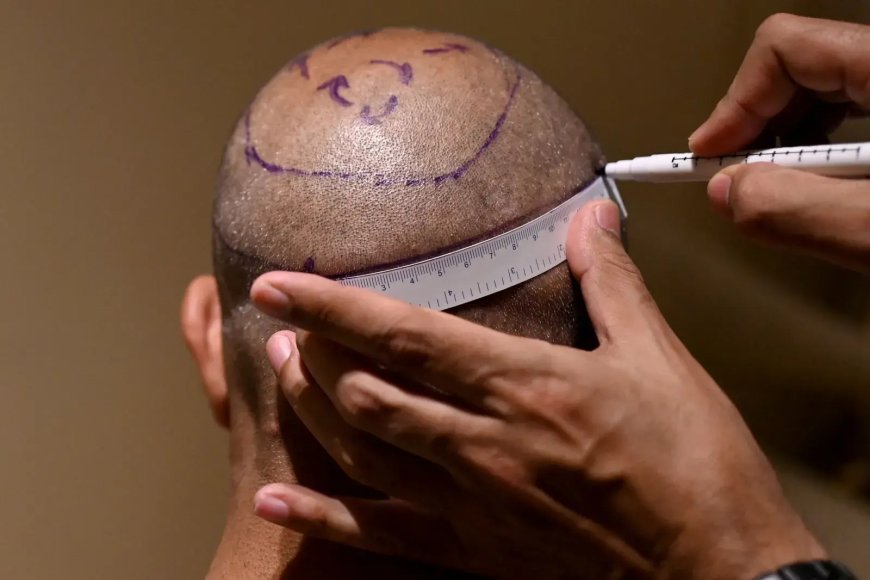 How to Find an Affordable Hair Transplant Clinic in Abu Dhabi