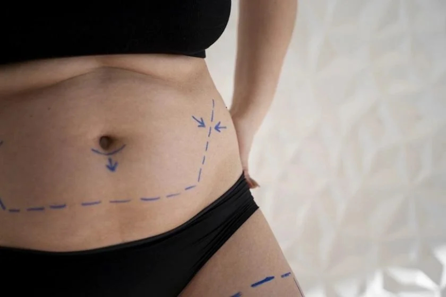 How Technology is Making Liposuction Safer and More Effective? 